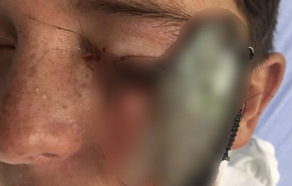  Menino de 11 anos é atingido por anzol durante pescaria; fotos impressionam!