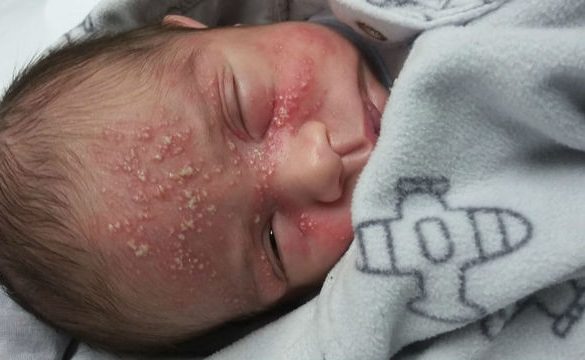  Bebê de 17 dias contrai herpes após beijo de visita e mãe alerta